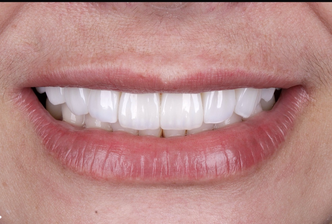 Caso 03, sorriso finalizado