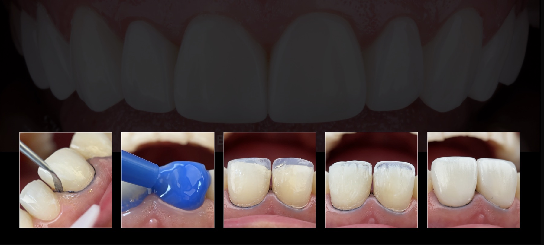 Sequência clínica de uma restauração estética em dente anterior, do preparo ao polimento final